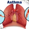 astma